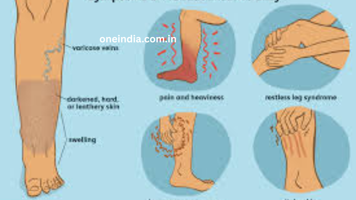 Chronic Venous Insufficiency (CVI): Causes, Symptoms, and Treatment
